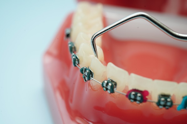 Braces Specialist: Your Path To Straighter Teeth