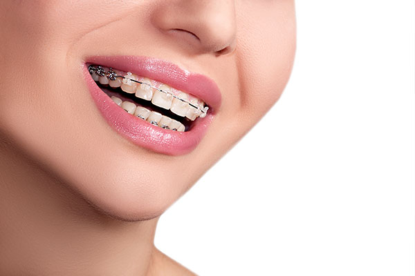 Aligners vs. Braces: How Are They Different?